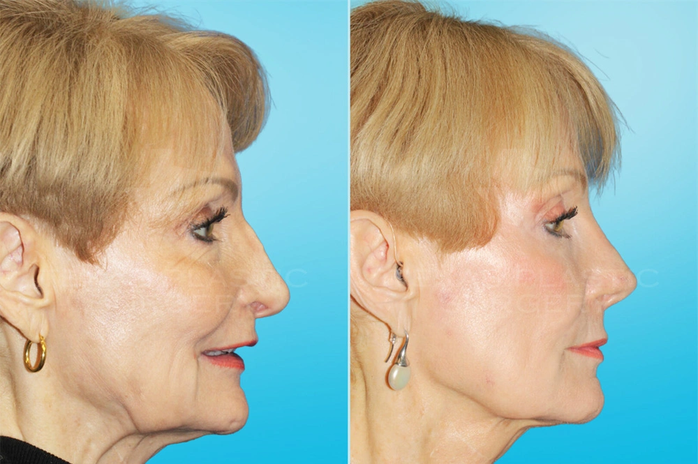 Real Patient results in San Antonio, TX Performed by Texas Plastic Surgery