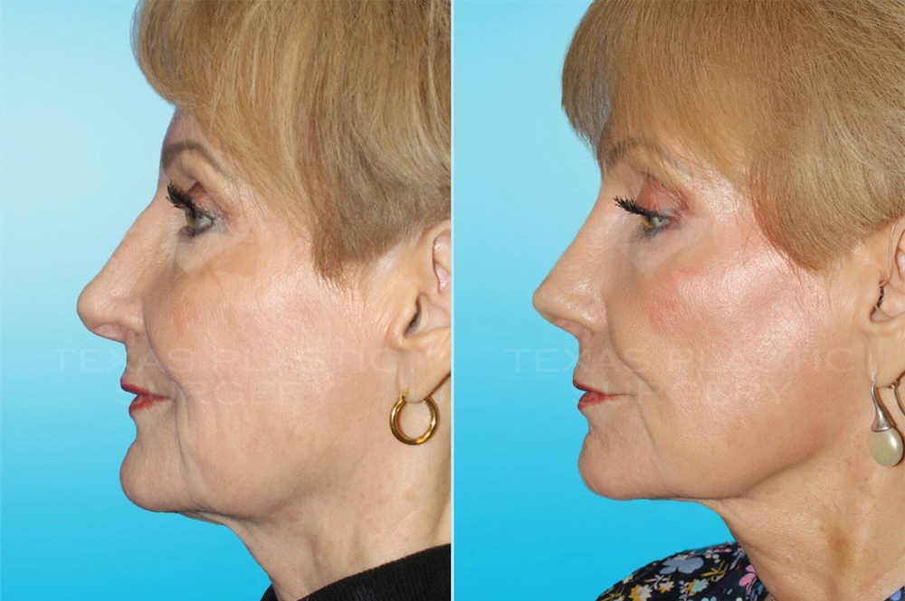 Real Patient results in San Antonio, TX Performed by Texas Plastic Surgery