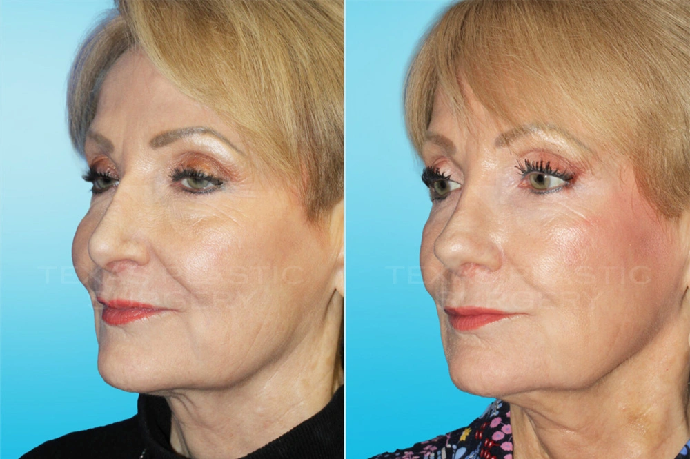 Real Patient results in San Antonio, TX Performed by Texas Plastic Surgery