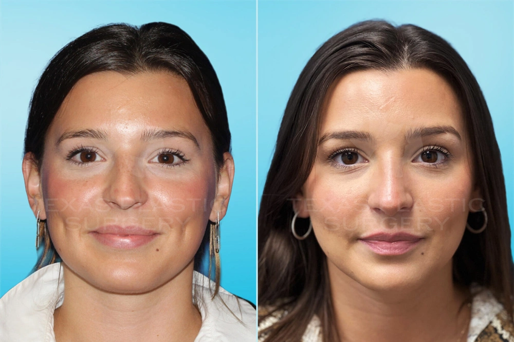 Real Patient results in San Antonio, TX Performed by Texas Plastic Surgery