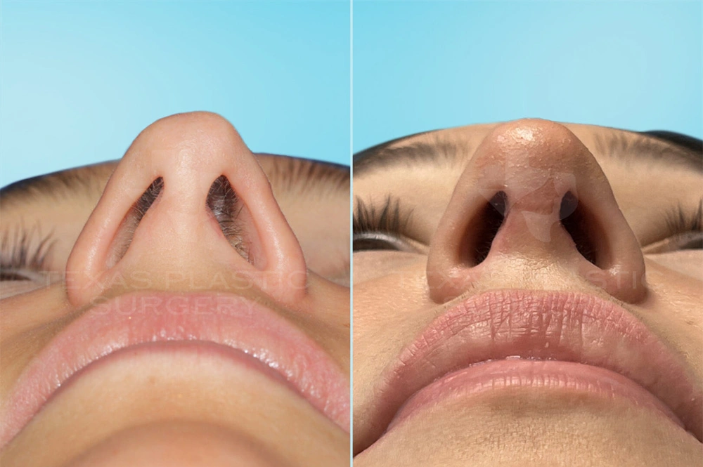 Real Patient results in San Antonio, TX Performed by Texas Plastic Surgery