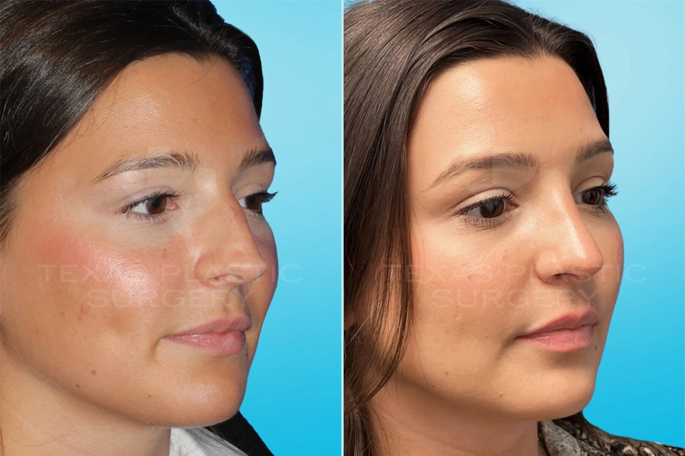 Real Patient results in San Antonio, TX Performed by Texas Plastic Surgery