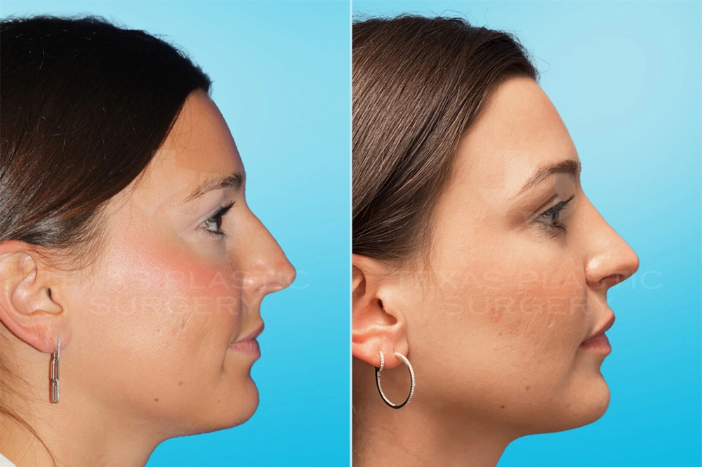 Real Patient results in San Antonio, TX Performed by Texas Plastic Surgery