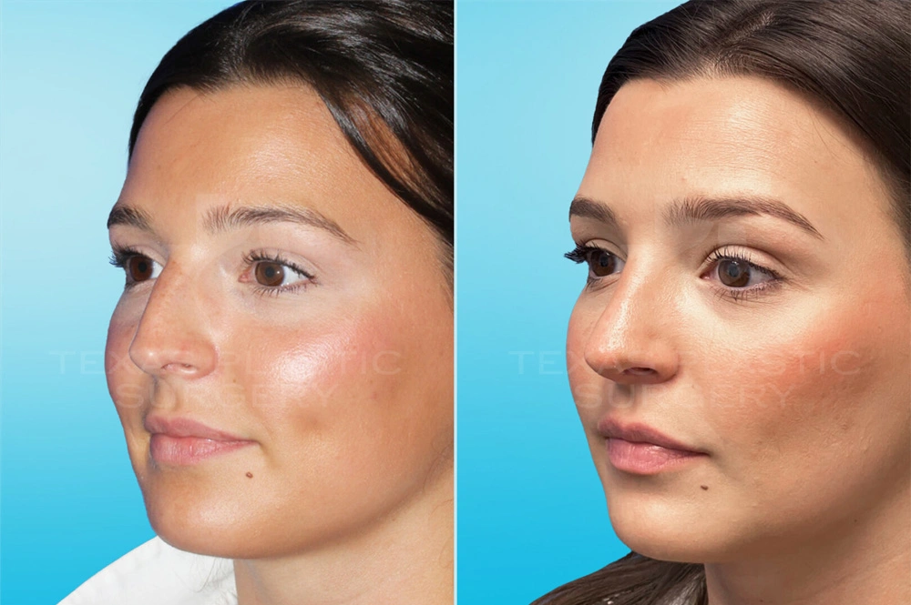 Real Patient results in San Antonio, TX Performed by Texas Plastic Surgery