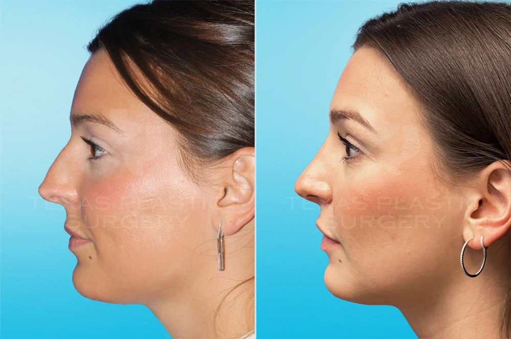 Real Patient results in San Antonio, TX Performed by Texas Plastic Surgery