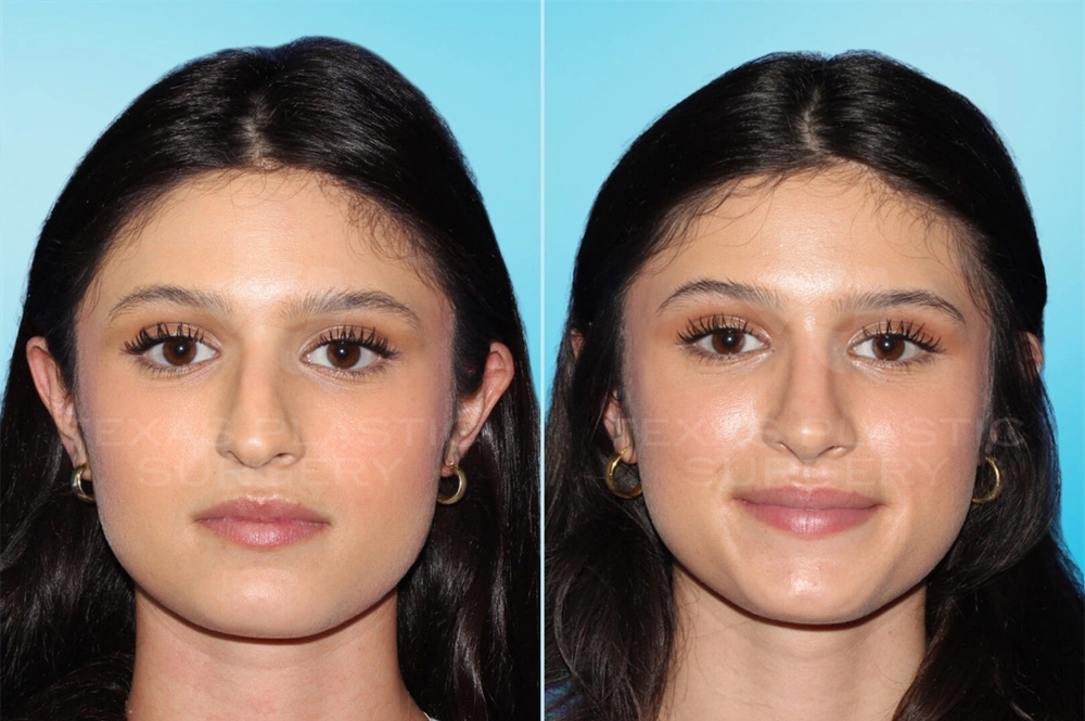 Real Patient results in San Antonio, TX Performed by Texas Plastic Surgery