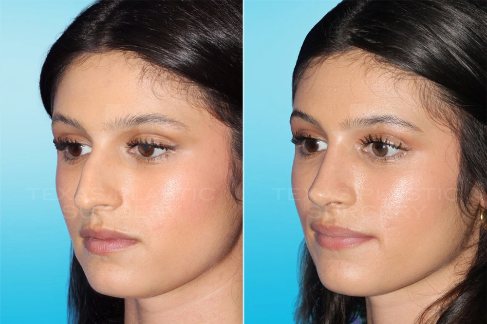 Real Patient results in San Antonio, TX Performed by Texas Plastic Surgery