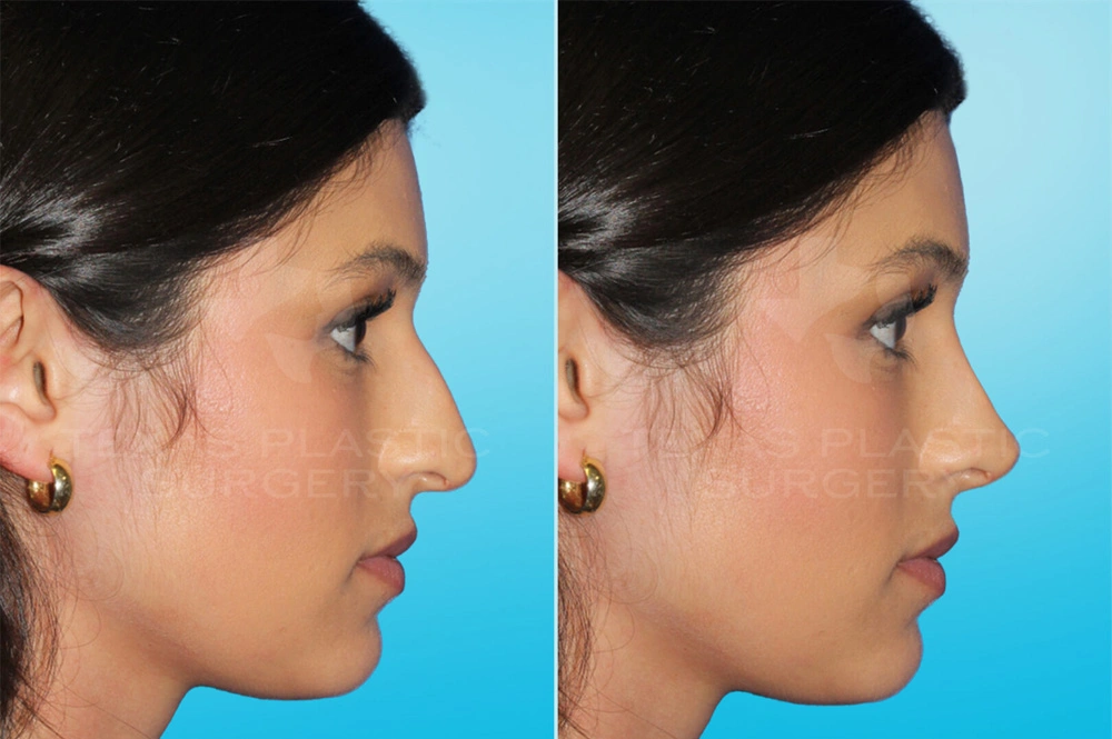 Real Patient results in San Antonio, TX Performed by Texas Plastic Surgery