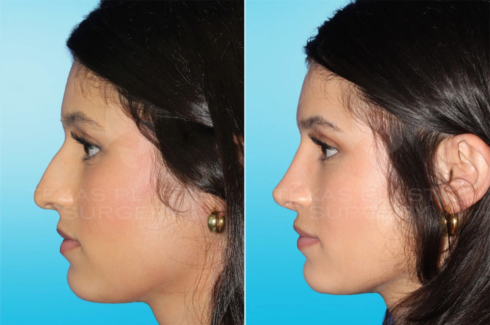 Real Patient results in San Antonio, TX Performed by Texas Plastic Surgery