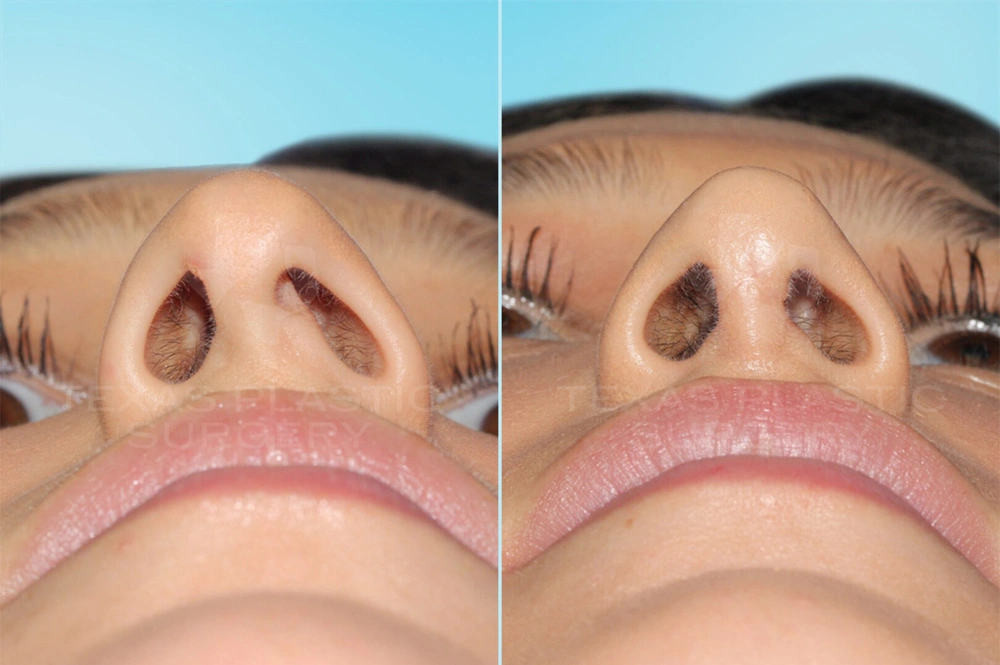 Real Patient results in San Antonio, TX Performed by Texas Plastic Surgery