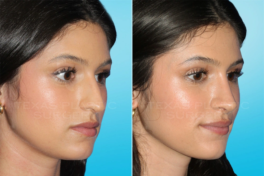 Real Patient results in San Antonio, TX Performed by Texas Plastic Surgery