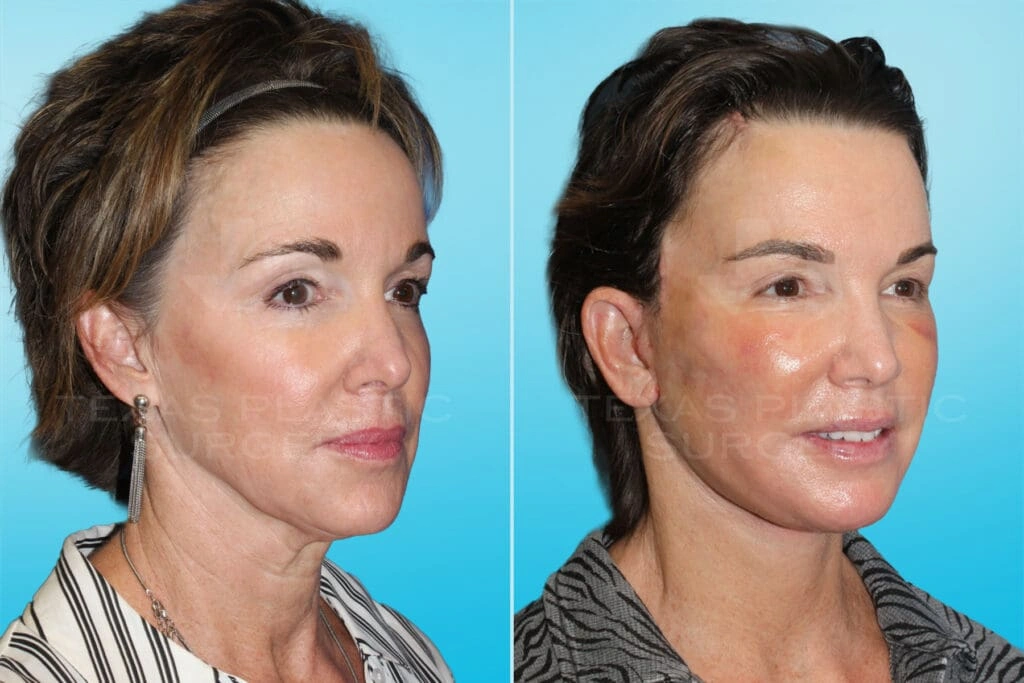 Real Patient results in San Antonio, TX Performed by Texas Plastic Surgery