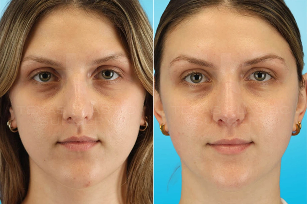 Real Patient results in San Antonio, TX Performed by Texas Plastic Surgery