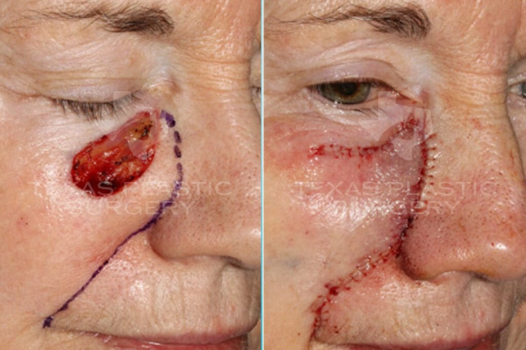 Real Patient results in San Antonio, TX Performed by Texas Plastic Surgery