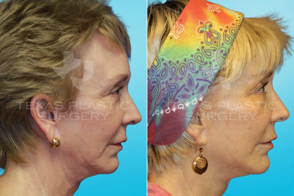 Real Patient results in San Antonio, TX Performed by Texas Plastic Surgery