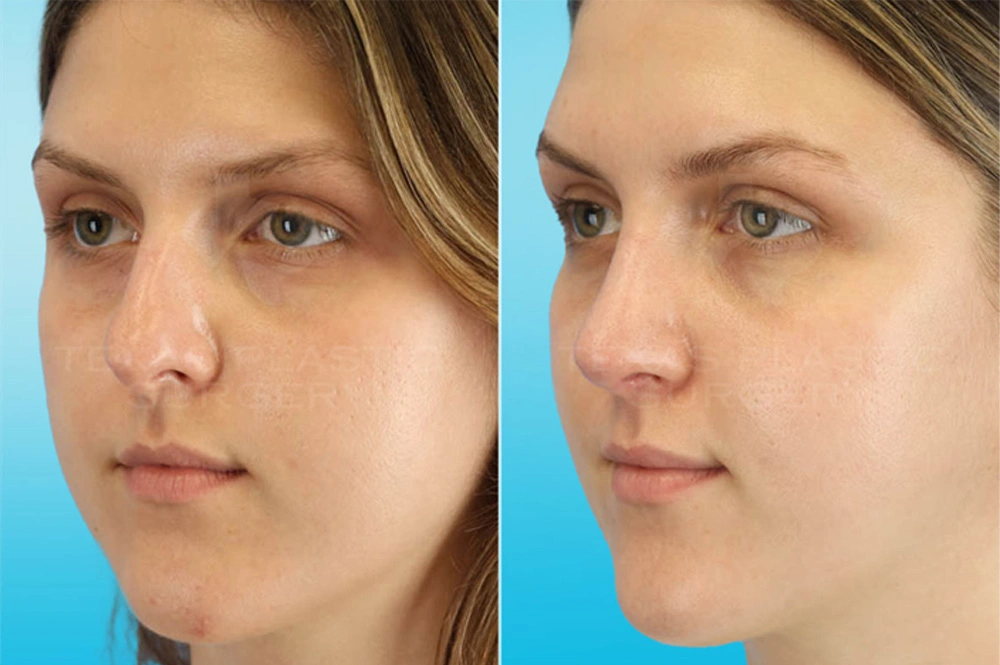 Real Patient results in San Antonio, TX Performed by Texas Plastic Surgery