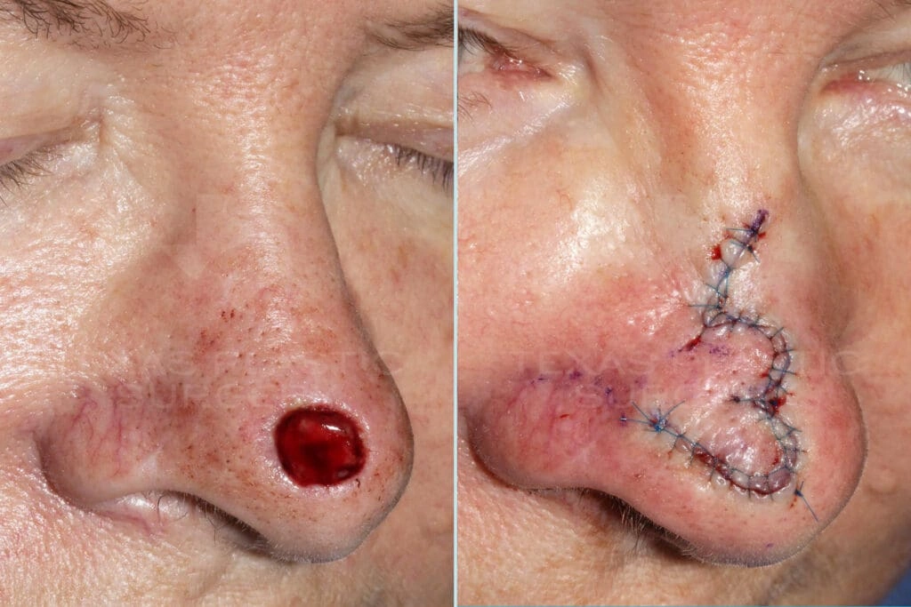 Real Patient results in San Antonio, TX Performed by Texas Plastic Surgery