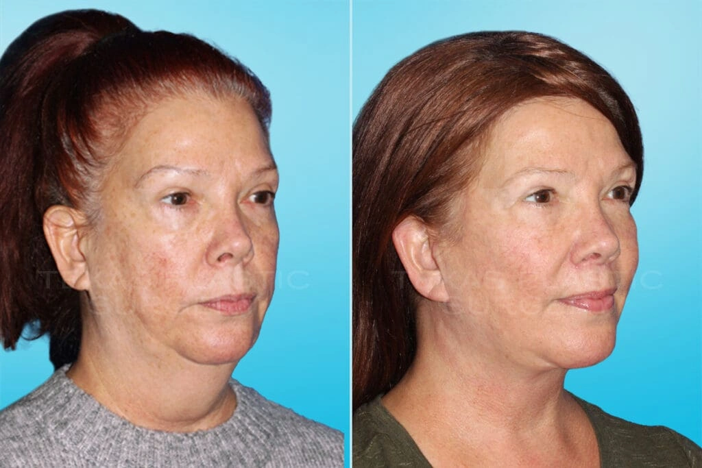 Real Patient results in San Antonio, TX Performed by Texas Plastic Surgery