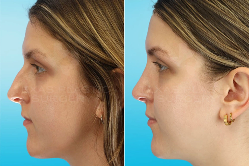 Real Patient results in San Antonio, TX Performed by Texas Plastic Surgery