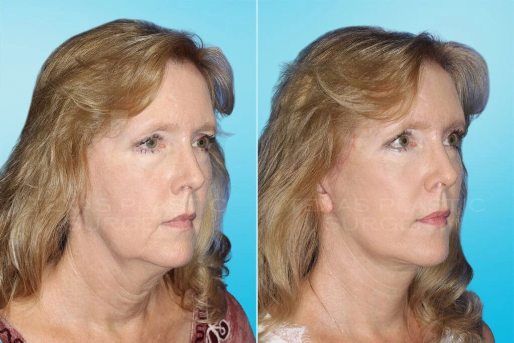 Real Patient results in San Antonio, TX Performed by Texas Plastic Surgery