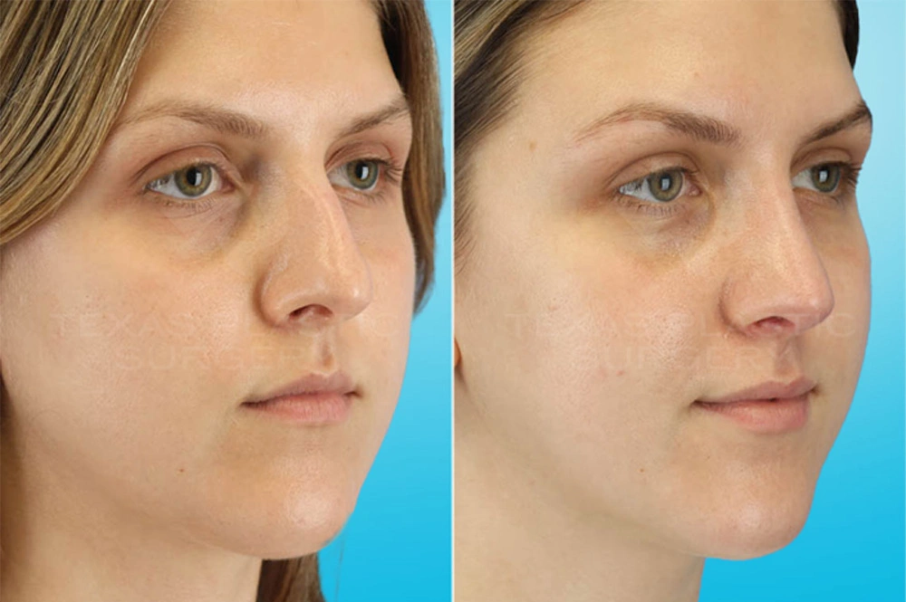 Real Patient results in San Antonio, TX Performed by Texas Plastic Surgery