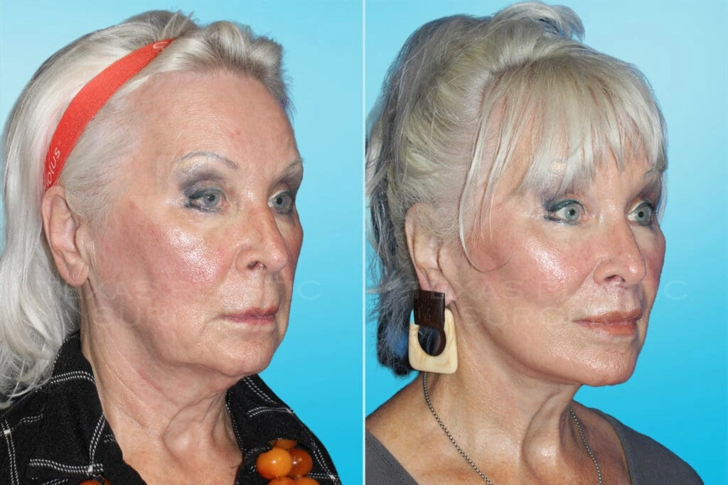 Real Patient results in San Antonio, TX Performed by Texas Plastic Surgery