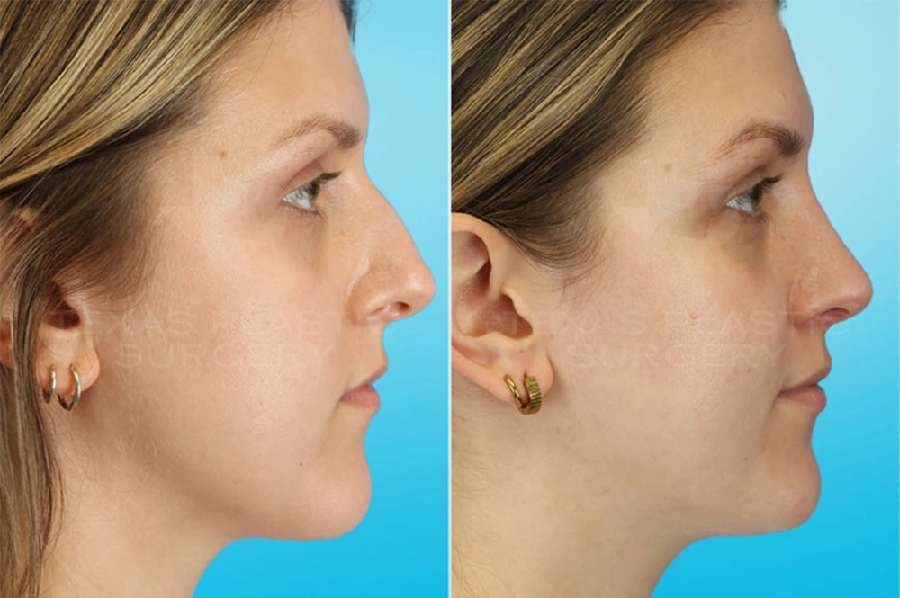 Real Patient results in San Antonio, TX Performed by Texas Plastic Surgery