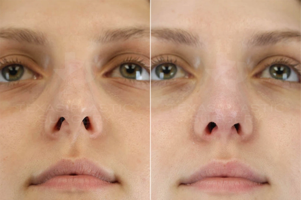 Real Patient results in San Antonio, TX Performed by Texas Plastic Surgery