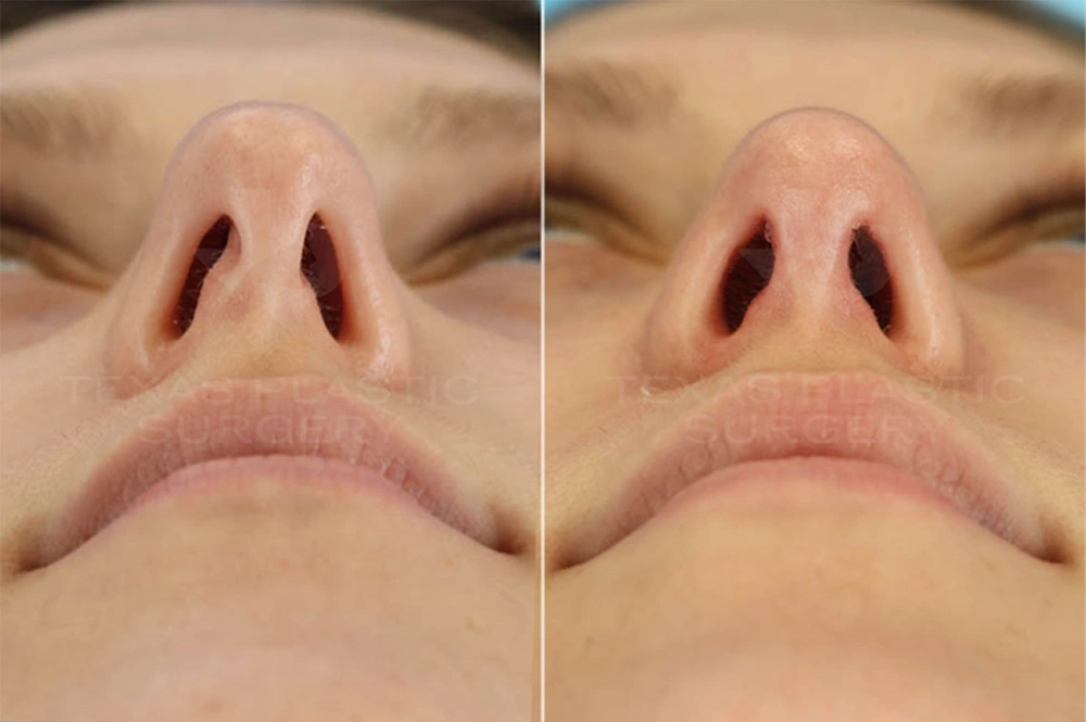 Real Patient results in San Antonio, TX Performed by Texas Plastic Surgery