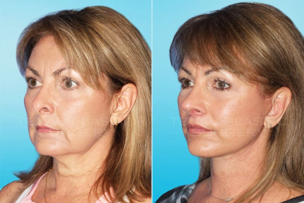 Real Patient results in San Antonio, TX Performed by Texas Plastic Surgery