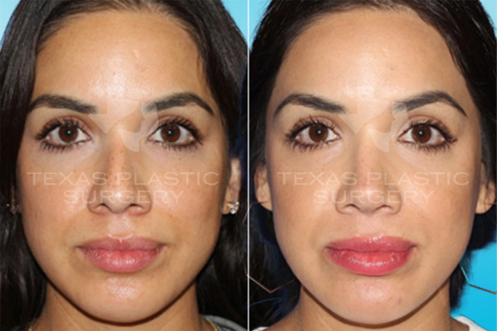 Real Patient results in San Antonio, TX Performed by Texas Plastic Surgery