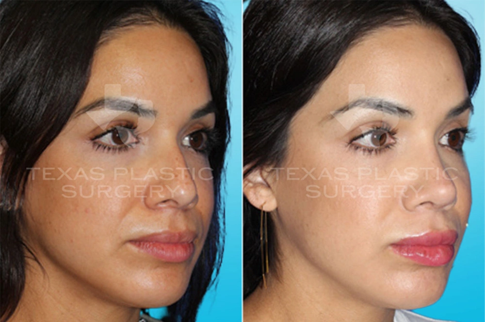 Real Patient results in San Antonio, TX Performed by Texas Plastic Surgery