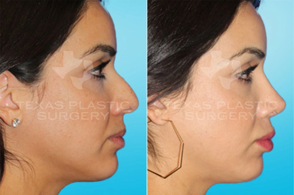 Real Patient results in San Antonio, TX Performed by Texas Plastic Surgery