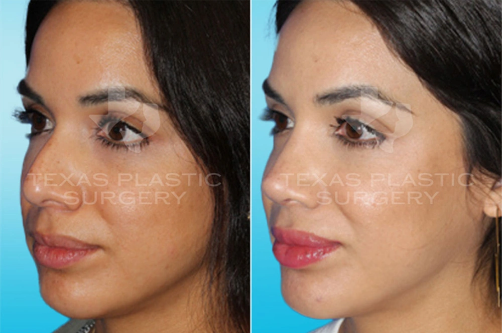 Real Patient results in San Antonio, TX Performed by Texas Plastic Surgery