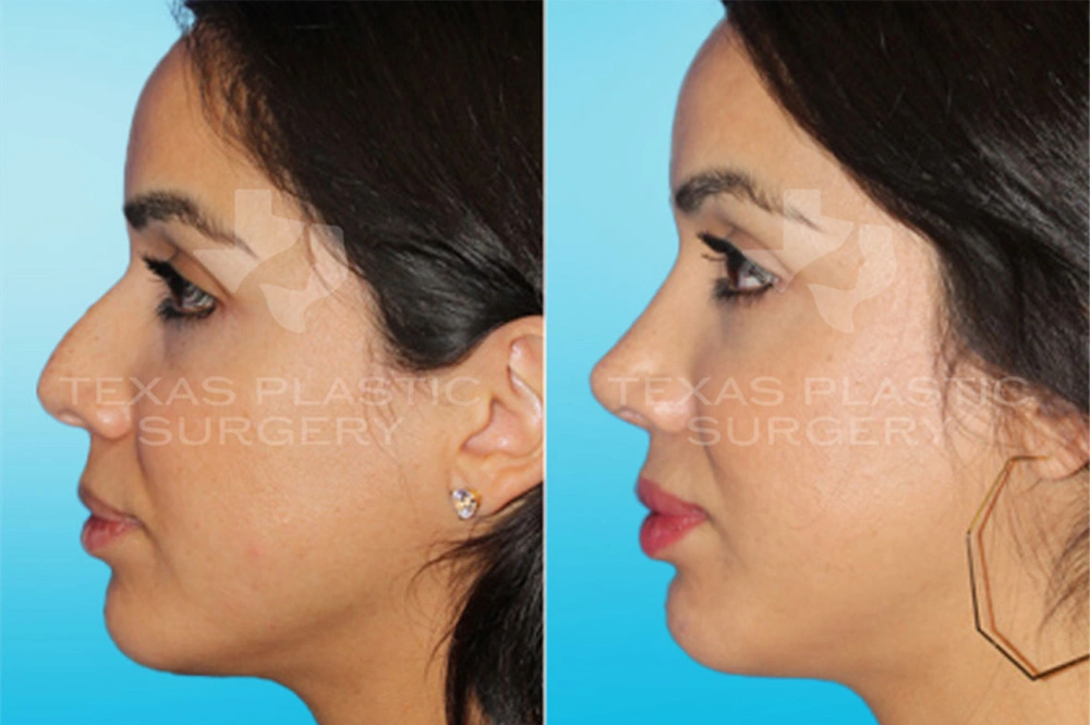 Real Patient results in San Antonio, TX Performed by Texas Plastic Surgery