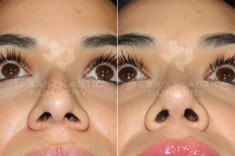 Real Patient results in San Antonio, TX Performed by Texas Plastic Surgery