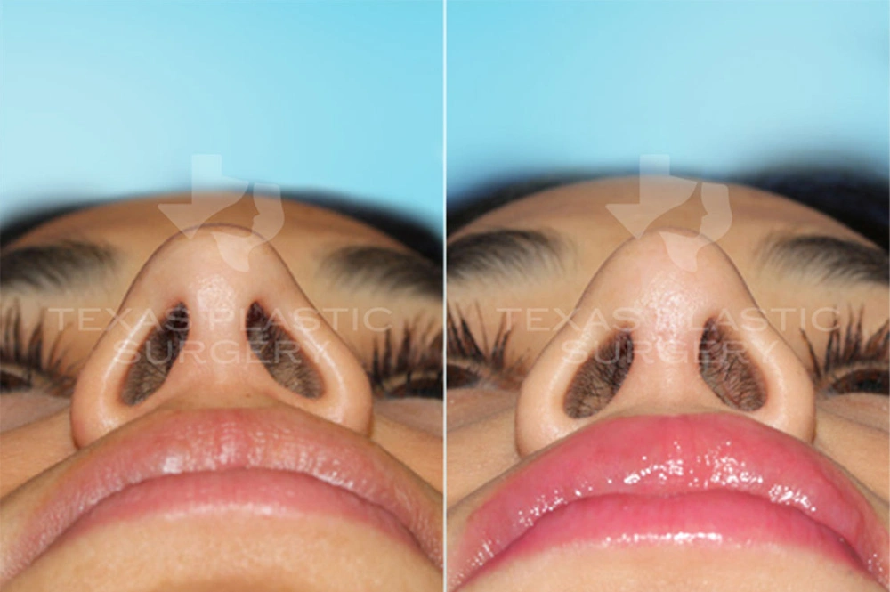 Real Patient results in San Antonio, TX Performed by Texas Plastic Surgery