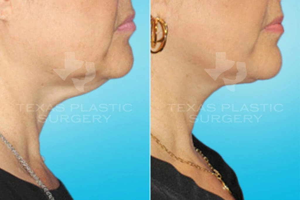 Real Patient results in San Antonio, TX Performed by Texas Plastic Surgery