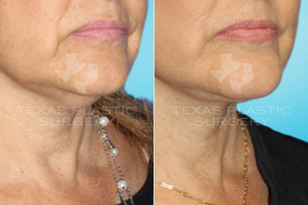 Real Patient results in San Antonio, TX Performed by Texas Plastic Surgery