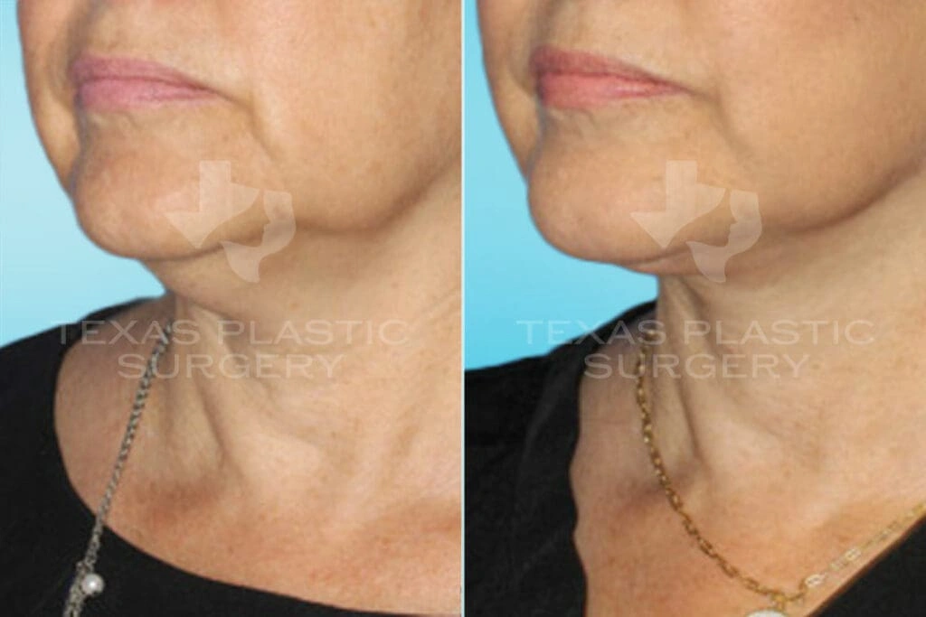 Real Patient results in San Antonio, TX Performed by Texas Plastic Surgery