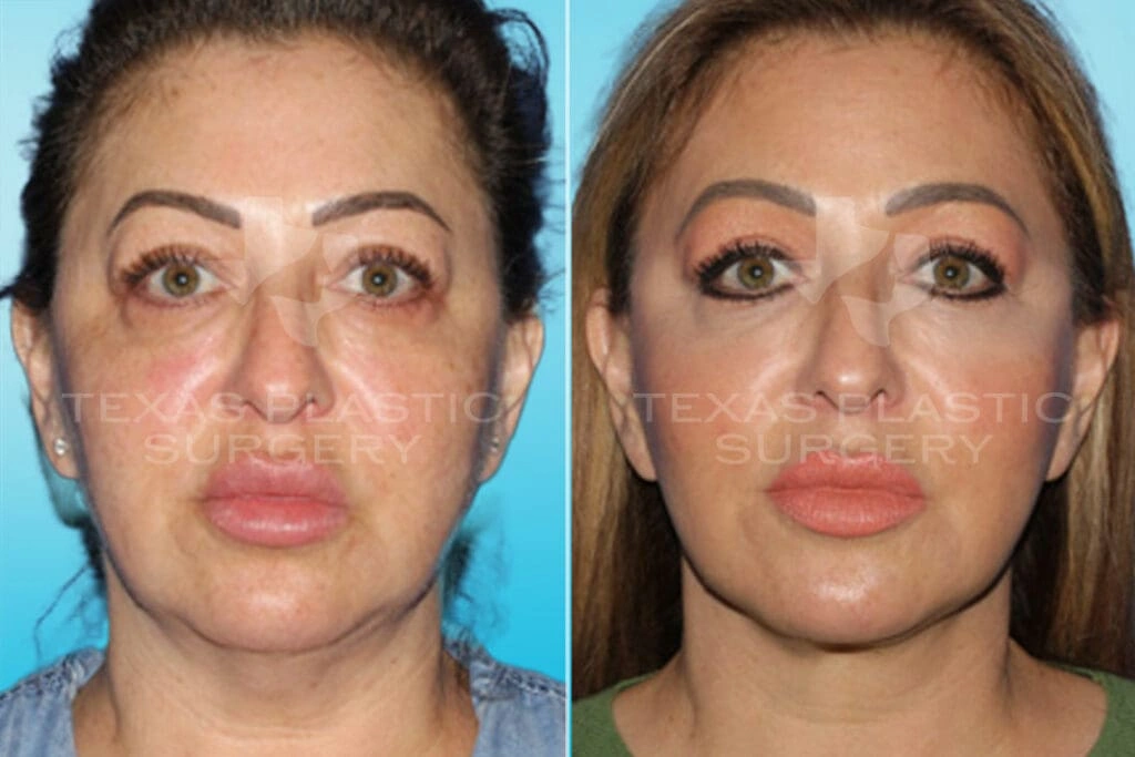 Real Patient results in San Antonio, TX Performed by Texas Plastic Surgery