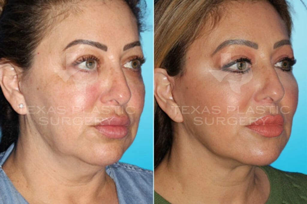 Real Patient results in San Antonio, TX Performed by Texas Plastic Surgery