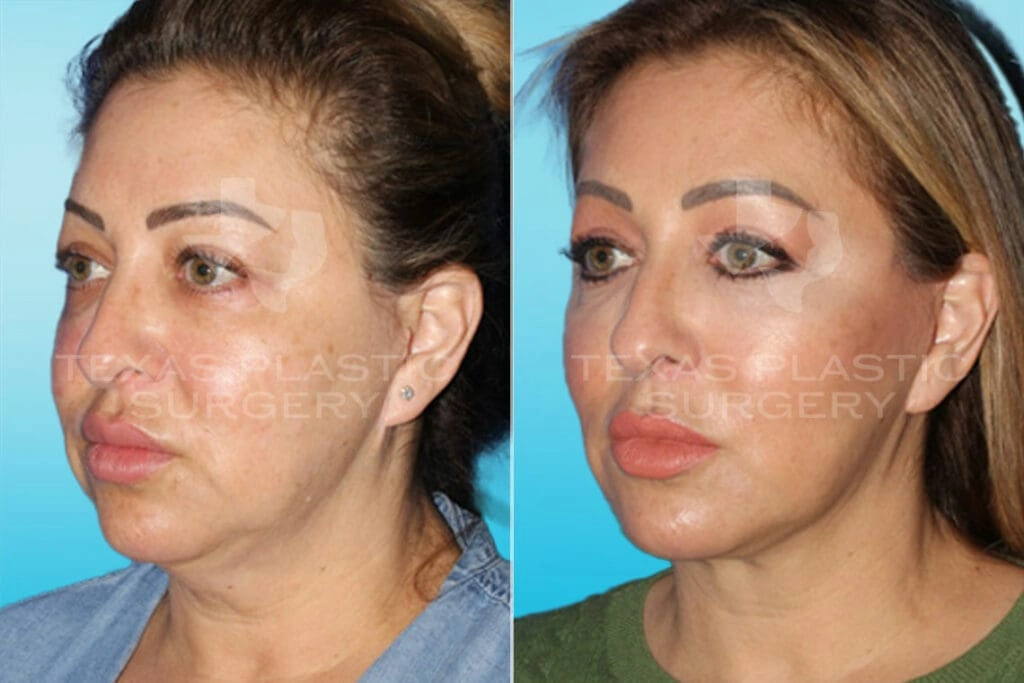 Real Patient results in San Antonio, TX Performed by Texas Plastic Surgery