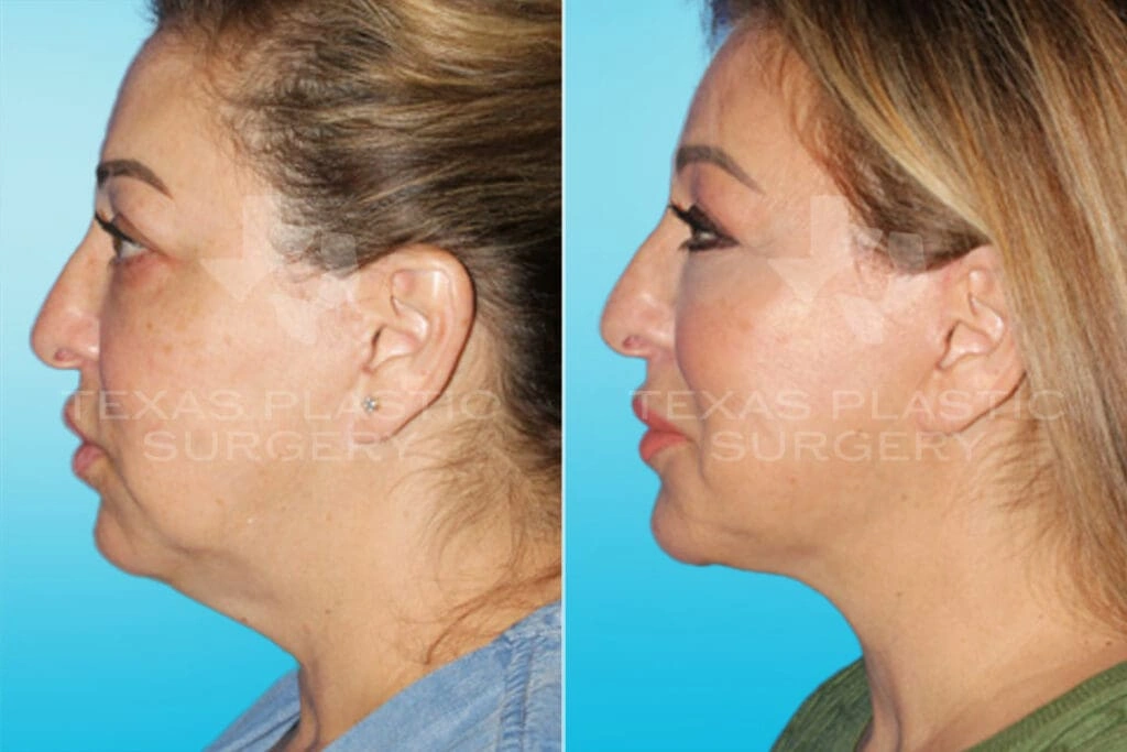 Real Patient results in San Antonio, TX Performed by Texas Plastic Surgery