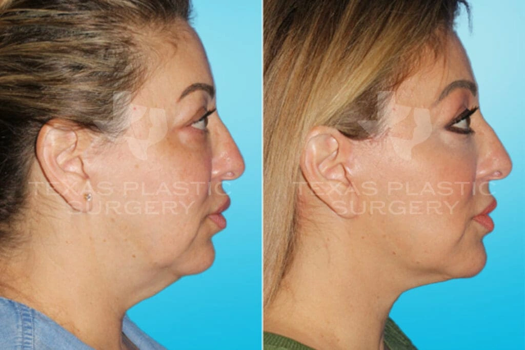 Real Patient results in San Antonio, TX Performed by Texas Plastic Surgery