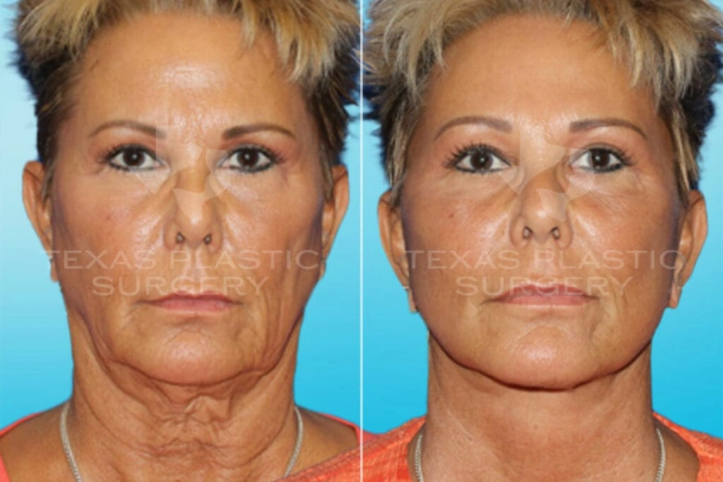 Real Patient results in San Antonio, TX Performed by Texas Plastic Surgery