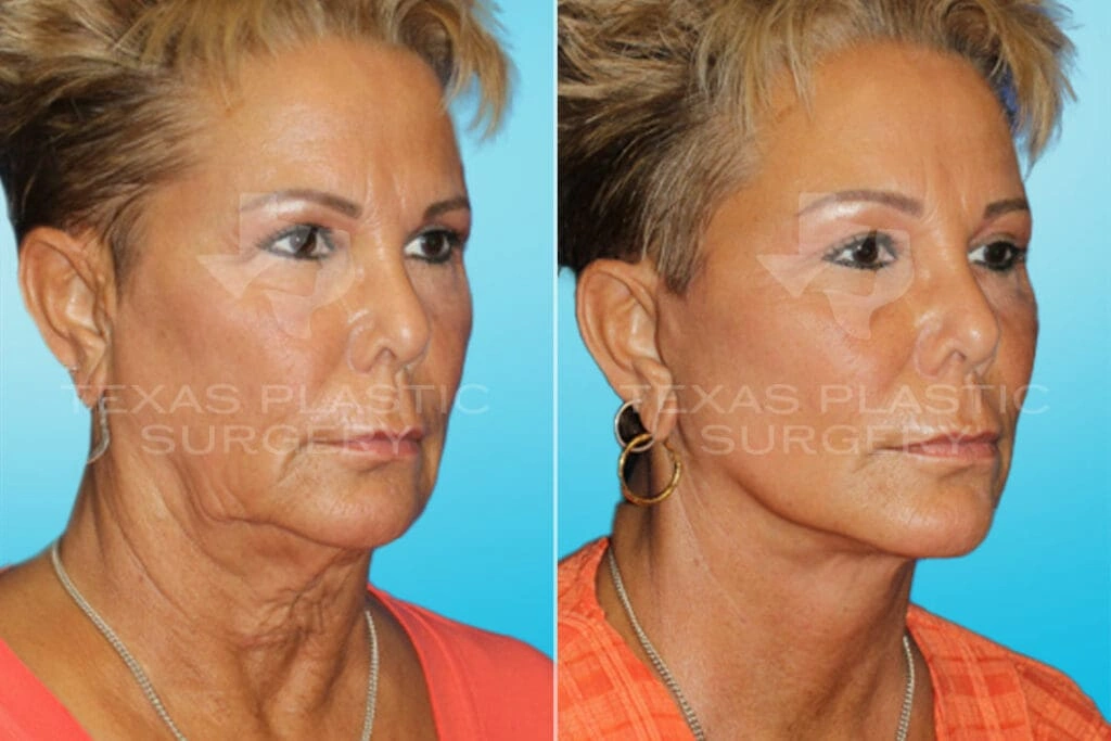 Real Patient results in San Antonio, TX Performed by Texas Plastic Surgery