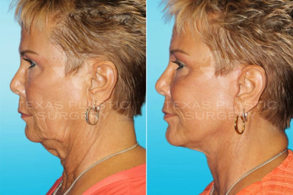 Real Patient results in San Antonio, TX Performed by Texas Plastic Surgery