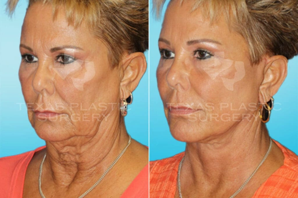 Real Patient results in San Antonio, TX Performed by Texas Plastic Surgery