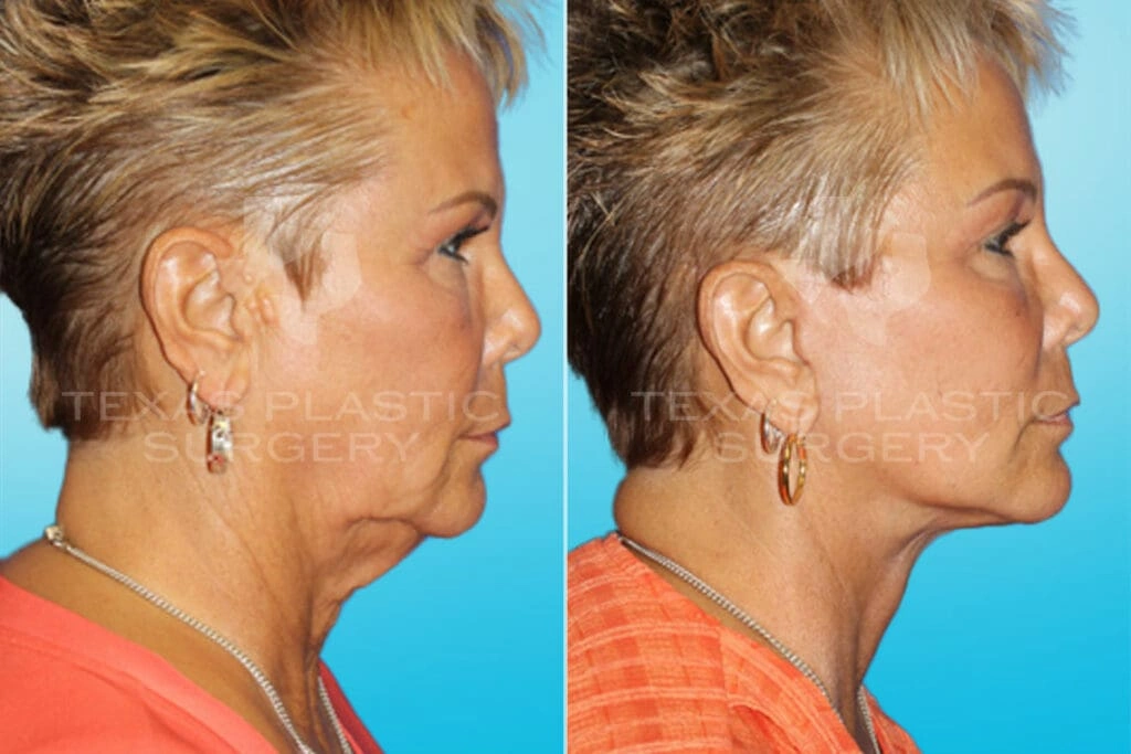 Real Patient results in San Antonio, TX Performed by Texas Plastic Surgery